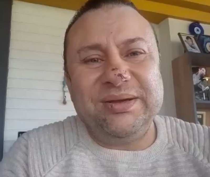 Pitbull saldırısında hastanelik olan Onur Akay o anları anlattı