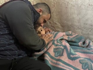 Kayseri'de köpek saldırısında yaralanan 3 yaşındaki bebek, 5 operasyon atlattı