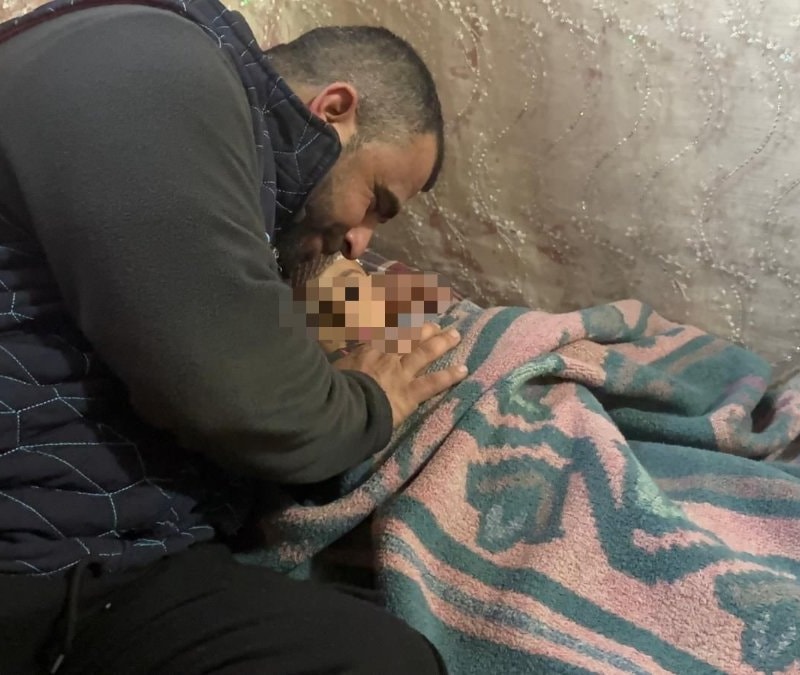 Kayseri'de köpek saldırısında yaralanan 3 yaşındaki bebek, 5 operasyon atlattı