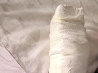 Mardin'de yürüyen merdivene eli sıkışan çocuk bir parmağını kaybetti