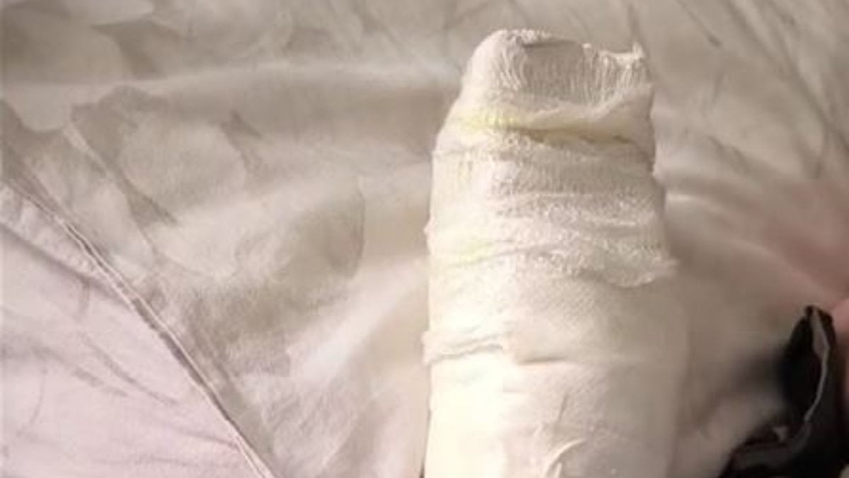 Mardin'de yürüyen merdivene eli sıkışan çocuk bir parmağını kaybetti