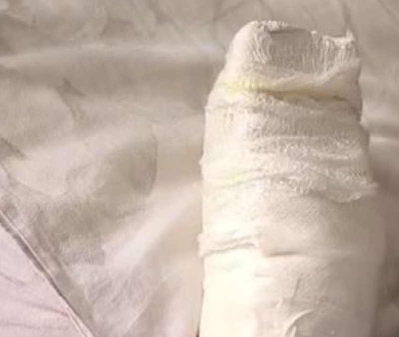 Mardin'de yürüyen merdivene eli sıkışan çocuk bir parmağını kaybetti