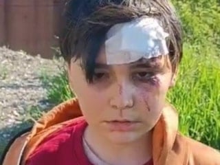 Kütahya'da başıboş köpeklerden kaçarken yaralandı