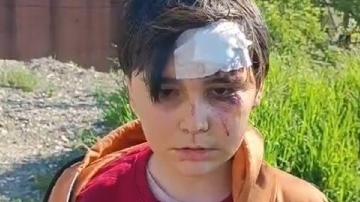 Kütahya'da başıboş köpeklerden kaçarken yaralandı