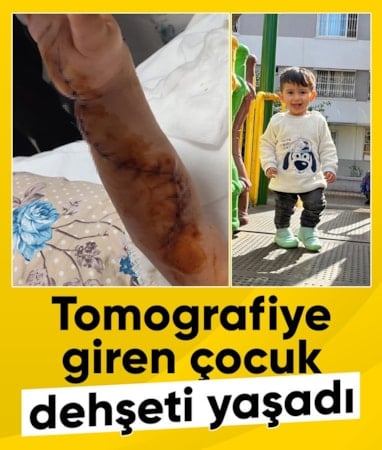 Adana'da tomografiye giren çocuk ölümden döndü