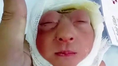 Kafatası oluşmadan doğdu: Bangladeş'te "anensefali" vakası