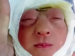 Kafatası oluşmadan doğdu: Bangladeş'te "anensefali" vakası