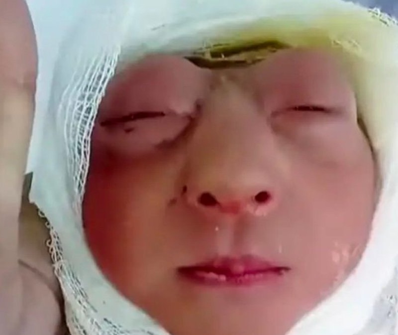 Kafatası oluşmadan doğdu: Bangladeş'te "anensefali" vakası