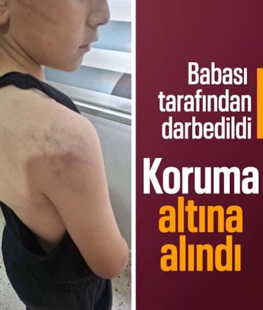 Manisa’da babasının darbettiği çocuk koruma altına alındı
