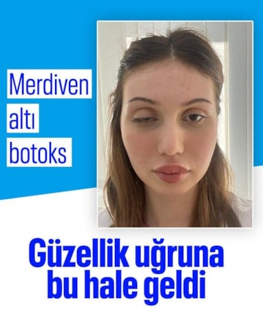 Merdiven altı botoks: Düğün hazırlığındaki gelin adayının göz kapağı düştü