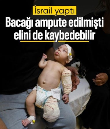 Gazze'de bacağı ampute edilen Muhammed bebek, şimdi de elini kaybedebilir