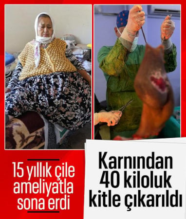 Aydın'da yaşayan kadının karnından 40 kilogram kitle çıkarıldı