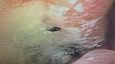 Aydın'da nadir vaka: Karnına giren böcek, ameliyatla çıkarıldı