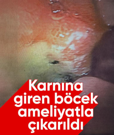 Aydın'da nadir vaka: Karnına giren böcek, ameliyatla çıkarıldı