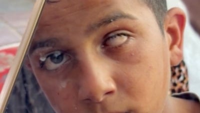 Gazze’de, İsrail askerinin silahıyla gözüne vurduğu Muhammed, gözünü kaybetti
