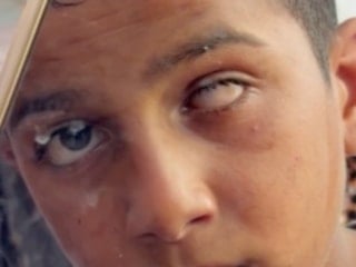 Gazze’de, İsrail askerinin silahıyla gözüne vurduğu Muhammed, gözünü kaybetti