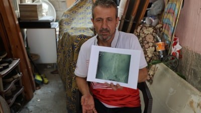 Adana'da ameliyat sırasında doktorlar, hastanın belinde panç unuttu