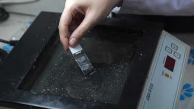 Dişlerden elde edilen kök hücreler 'çikolata kisti' tedavisinde umut oldu