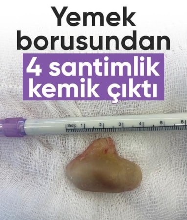 İstanbul'da yaşlı adamın yemek borusundan 4 santimlik kemik çıktı