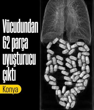 Konya'da vücudundan 62 parça uyuşturucu çıktı