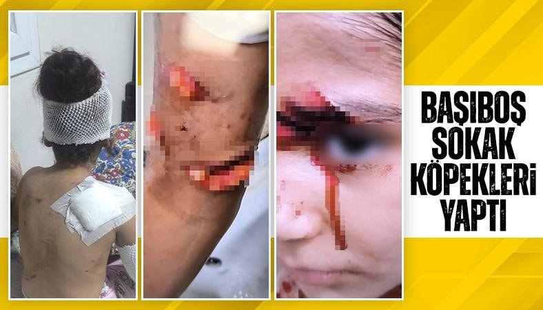 Şanlıurfa'da başıboş köpeklerin saldırısına uğrayan çocuğa 150 dikiş atıldı