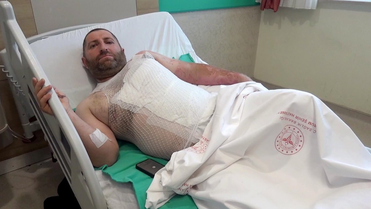 Erzincan'da elektrik akımına kapıldı: Vücudunun 3'te 1'i yandı