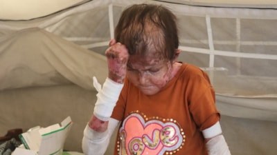 Gazze'de genç kız nadir cilt hastalığıyla mücadele ediyor