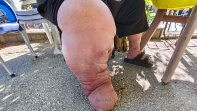 Edirneli fil hastası tedavi olabilmek için kilo verecek