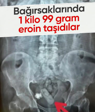 Erzincan'da yakalanan şüphelilerin mide ve bağırsağından uyuşturucu çıktı