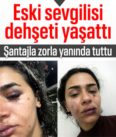 İstanbul'da eski sevgilisi tarafından darbedildi