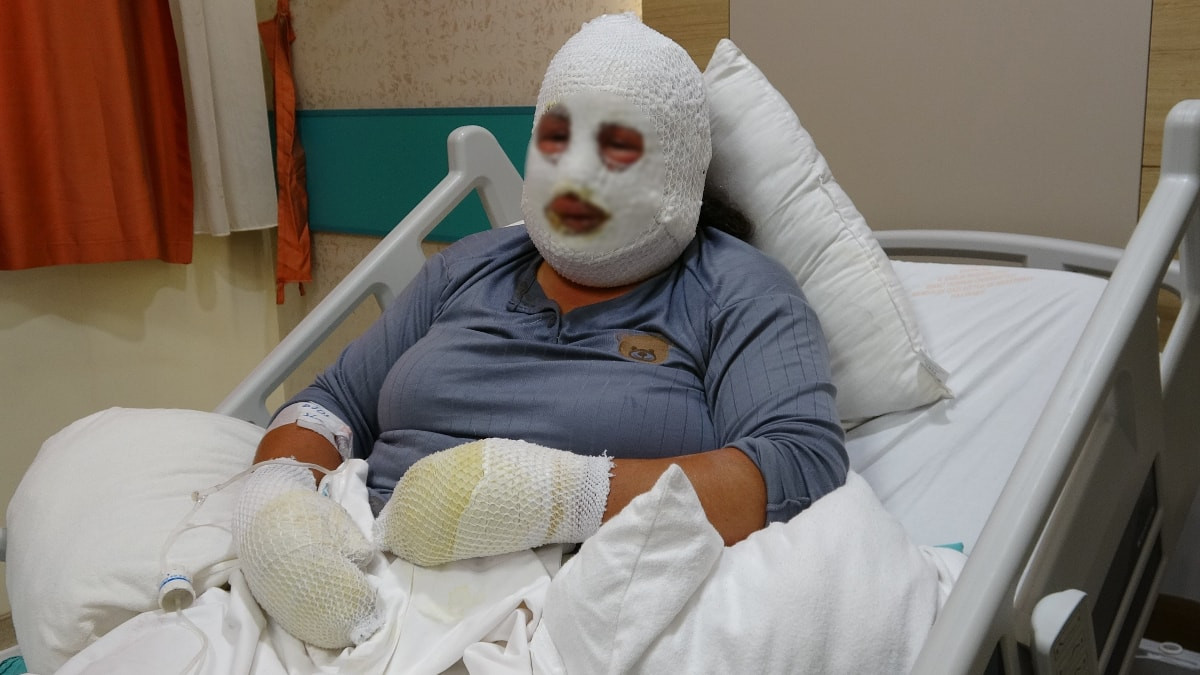 Ardahan'da kızını kurtarmak için alevlerin arasına girdi, kendisi de yandı