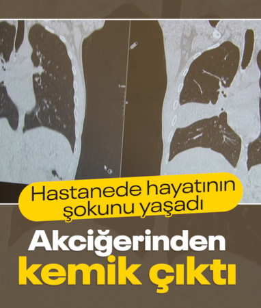 İstanbul’da hastanın akciğerinden kemik çıktı