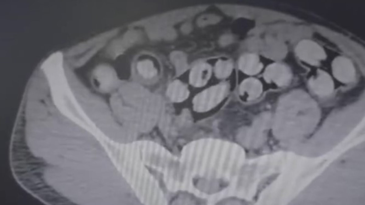 Kırşehir'de 1 kilo 159 gram uyuşturucuyu vücudunda taşıyan şüpheli tutuklandı