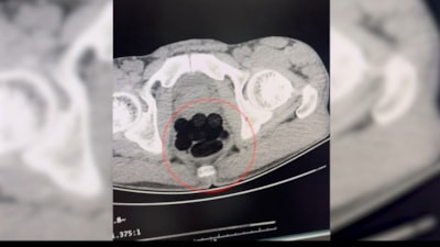 Batman'da yabancı uyruklu şüphelinin midesinden 253 gram eroin çıktı