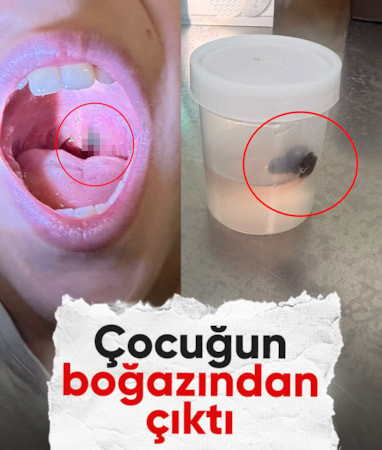 Siirt'te 10 yaşındaki çocuğun boğazından canlı sülük çıktı