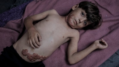 İsrail saldırısının hedefi olan çocuklardan biri: Muhammed