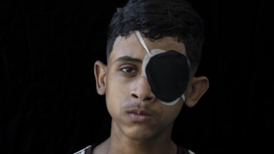 Gazze'de binlerce çocuk İsrail saldırılarında uzuvlarını kaybetti