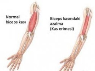 Fasiyo skapulo humeral müsküler distrofi nedir