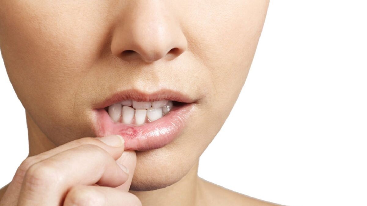 Ağız ülserleri, çölyak hastalığının habercisi olabilir