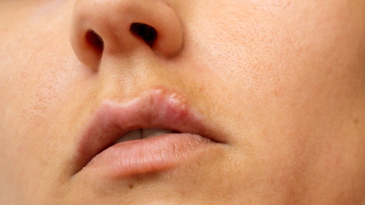 Uçukları hızlı bir şekilde tedavi etmek için 8 yöntem