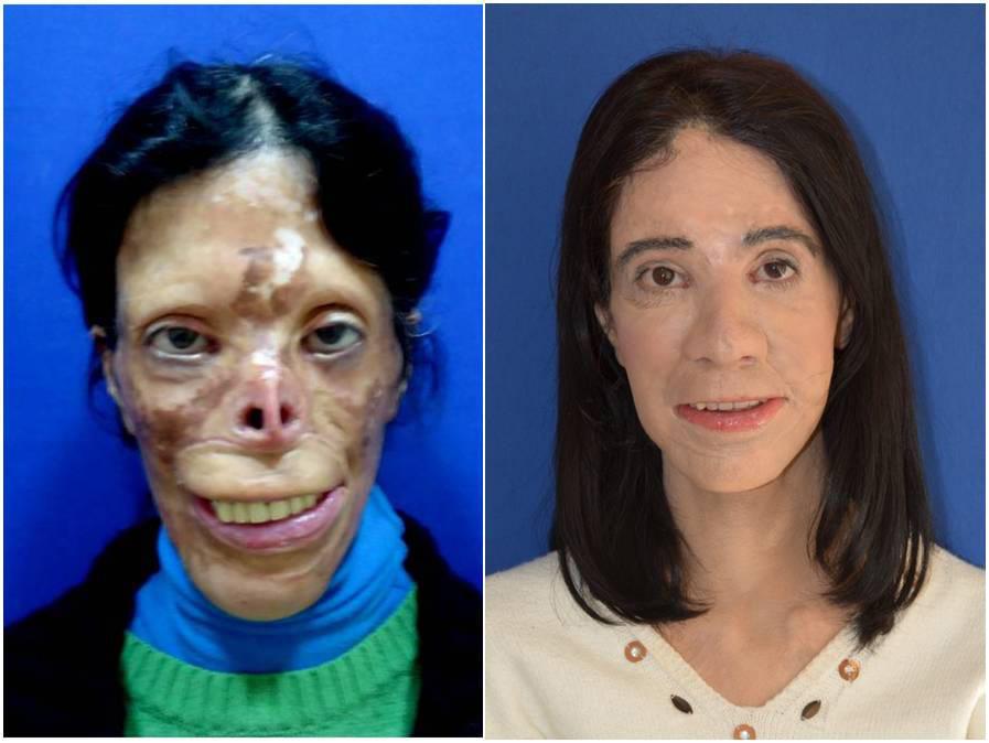 Türk doktordan dünyanın konuştuğu yüz nakli