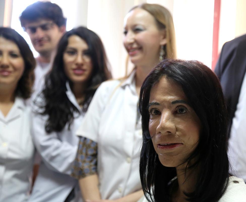 Türk doktordan dünyanın konuştuğu yüz nakli