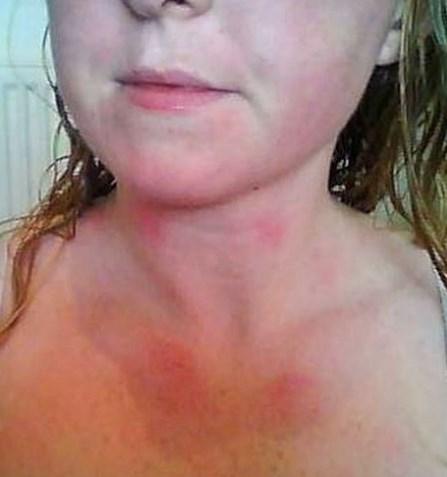 Su alerjisi kadınları tehdit ediyor