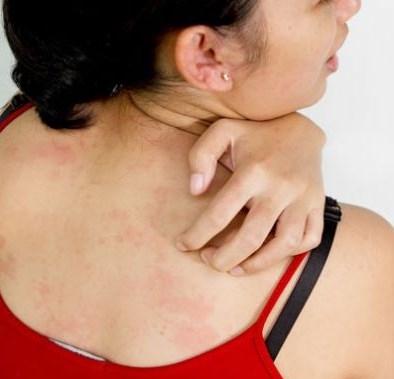 Su alerjisi kadınları tehdit ediyor