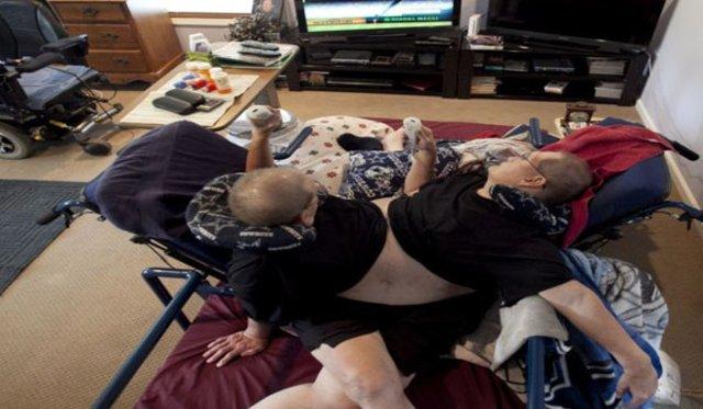 ABD'li ikizler 62 yıldır birbirlerine yapışık yaşıyorlar