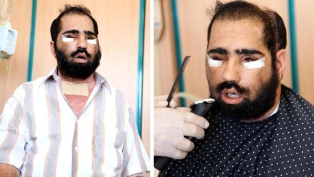 Yüz naklini yapan doktor ağlamaklı oldu