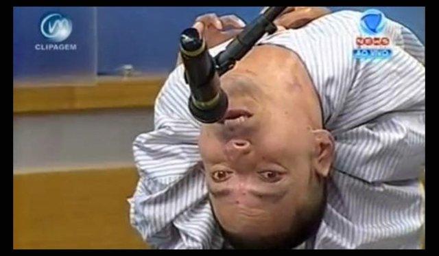 Brezilya'da boynu ters doğan adam 37 yaşında