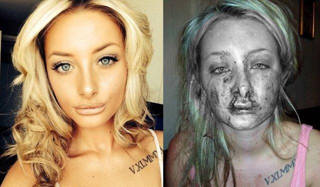 Kıskanç genç sevgilisinin üst dudağını kopardı