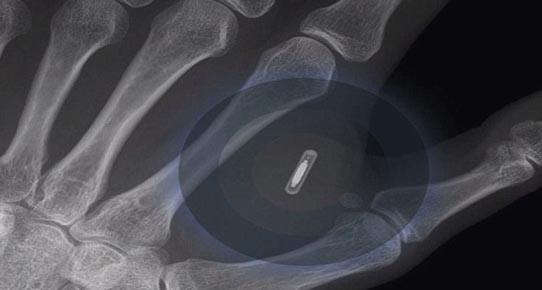 Avustralya'da bir kişi iPhone için eline çip taktırdı