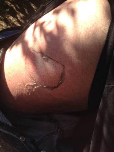 iPhone 6 Phillip'in bacağını yaktı